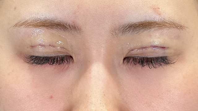 手术前的状态 其一