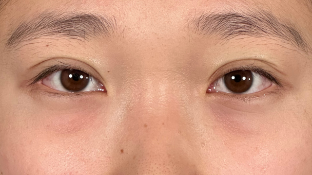 手術前の状態 その1