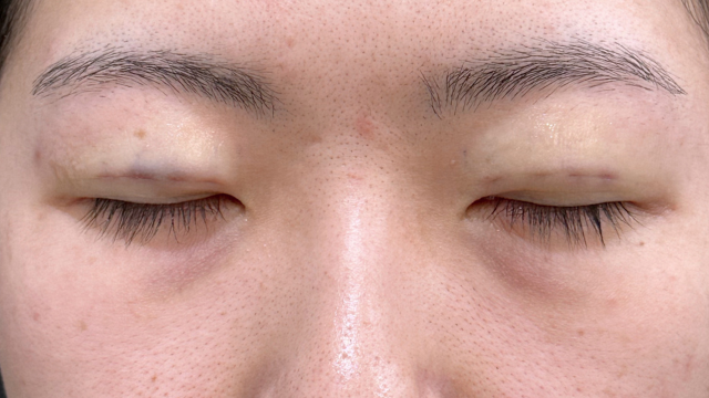 手術前の状態 その1