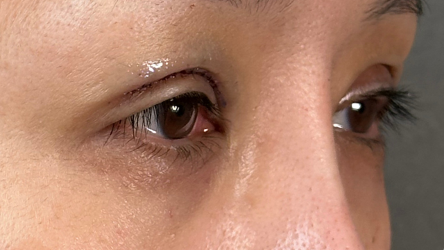 手術前の状態 その1