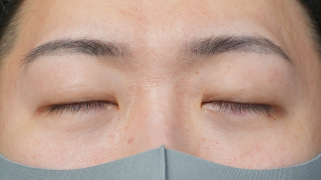 手术前的状态 其一