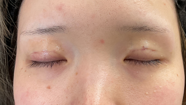 手術前の状態 その1