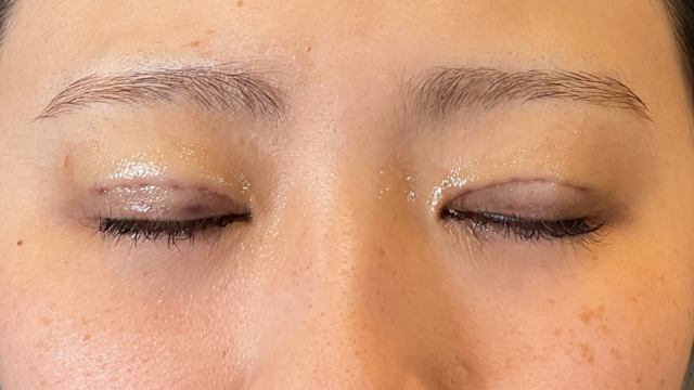 手术前的状态 其一