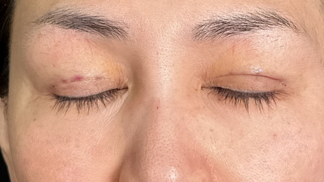 手术前的状态 其一