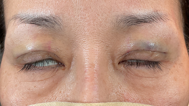 手術前の状態 その1