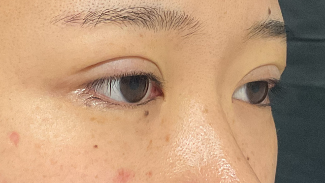 手术前的状态 其一