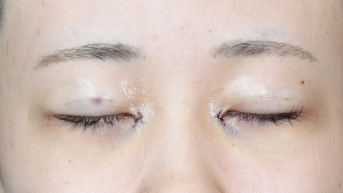 手術前の状態 その1