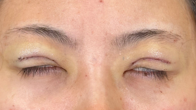 手術前の状態 その1