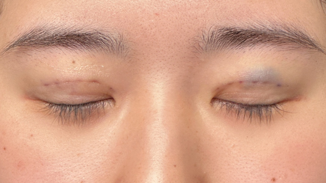 手术前的状态 其一