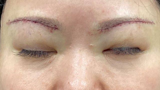 手术前的状态 其一