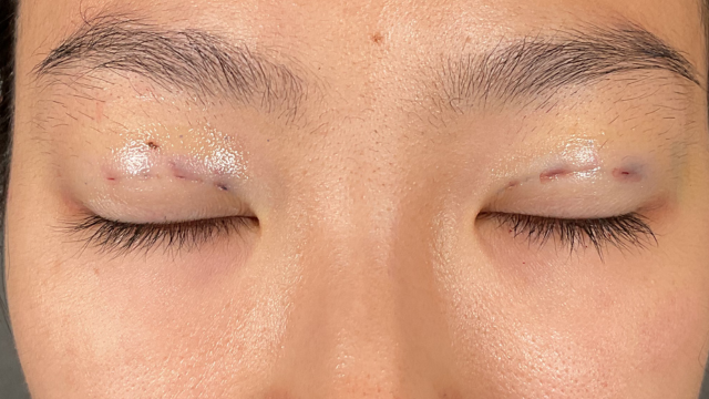 手术前的状态 其一