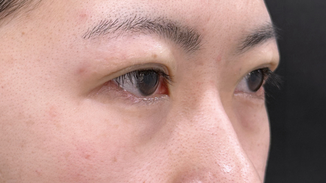 手術前の状態 その1