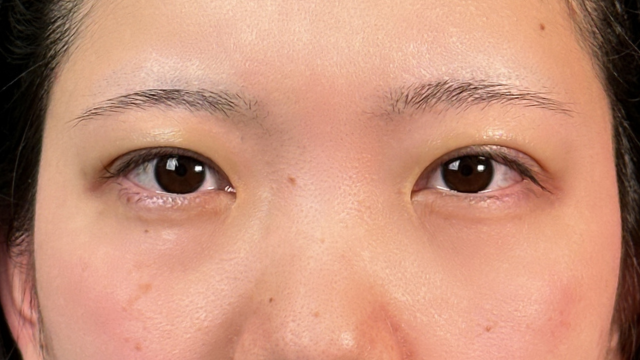 手术前的状态 其一