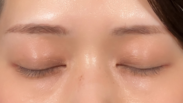 手術前の状態 その1