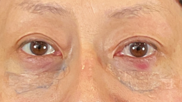 Postoperative Condition Part 1