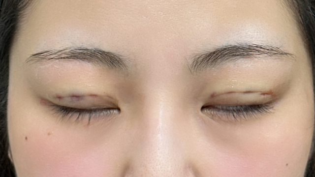 手術前の状態 その1