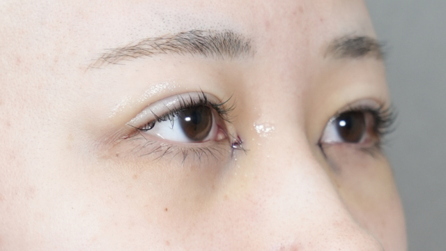 手術前の状態 その1