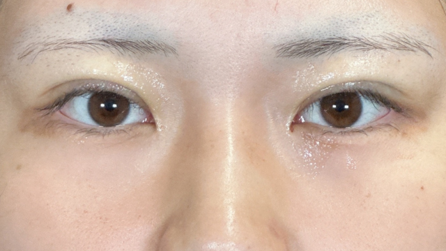 手術前の状態 その1