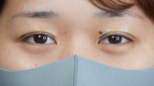 手術前の状態 その1