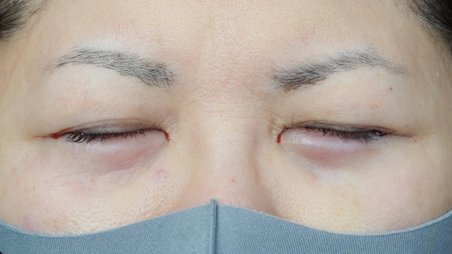 手術前の状態 その1