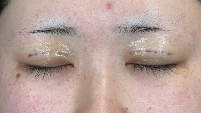 手術前の状態 その1