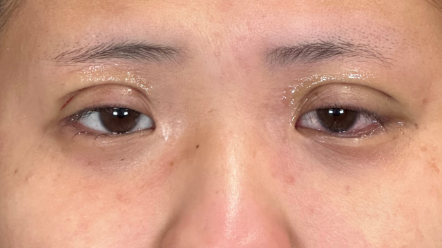 手术前的状态 其一