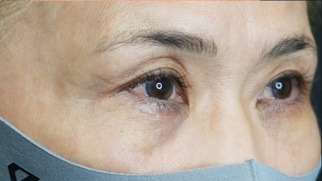 手术前的状态 其一