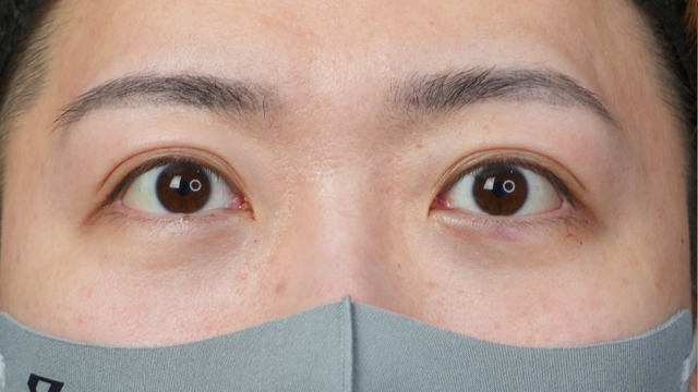 手术前的状态 其一