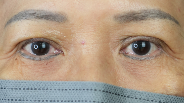 手术前的状态 其一