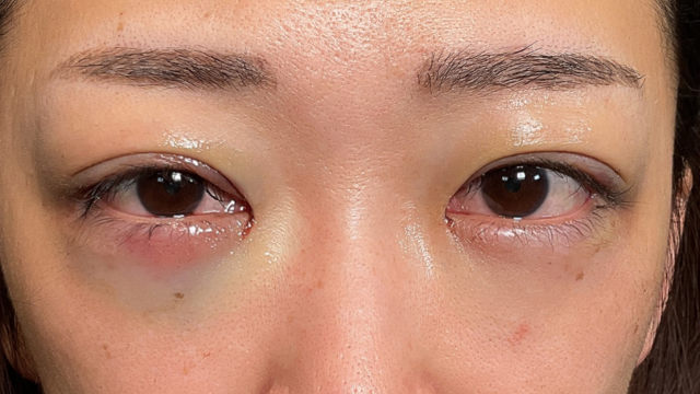 手術前の状態 その1