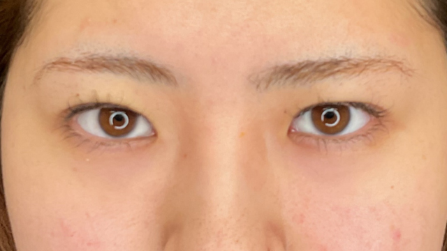 手術前の状態 その1