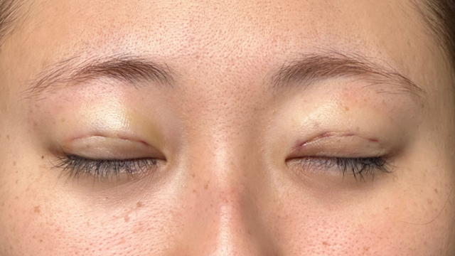 手術前の状態 その1