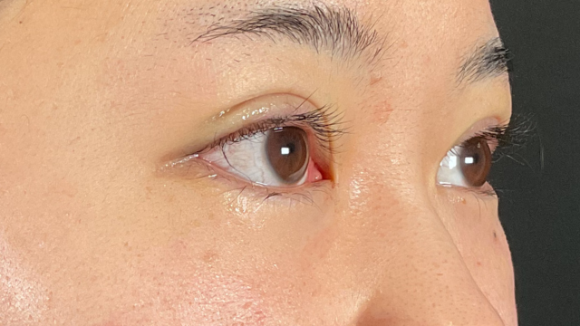 手术前的状态 其一