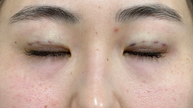 手术前的状态 其一