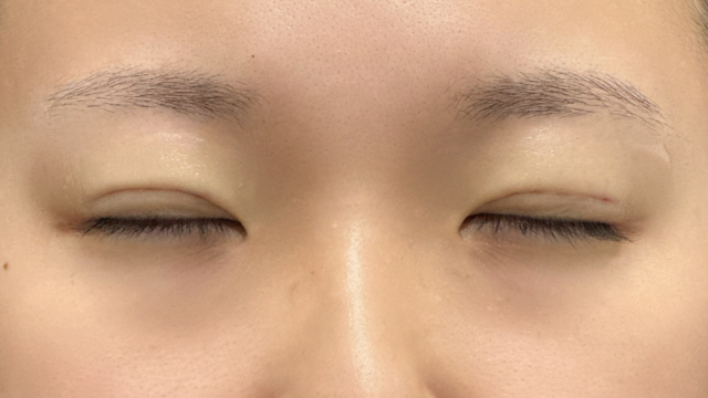 手术前的状态 其一