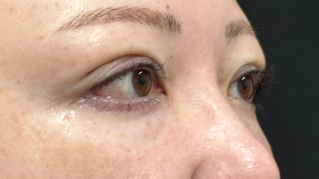 手术前的状态 其一