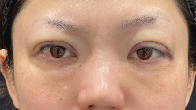 手術前の状態 その1