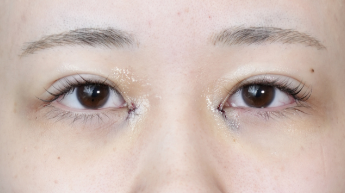 手術前の状態 その1