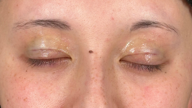 手术前的状态 其一