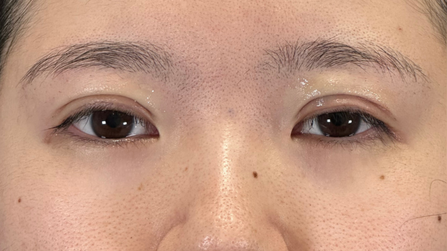 手术前的状态 其一