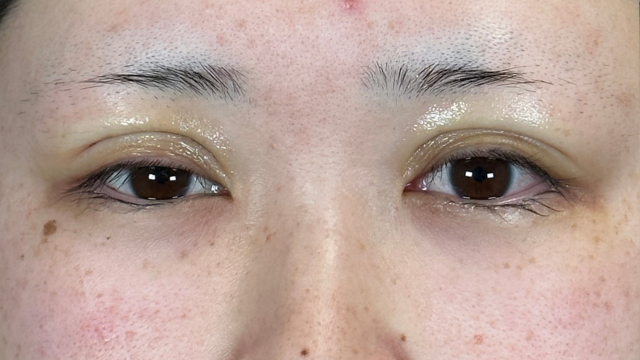 手術前の状態 その1