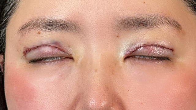 手術前の状態 その1