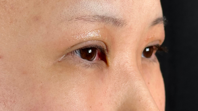 手术前的状态 其一