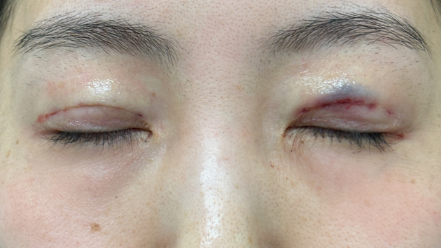 Postoperative Condition Part 1