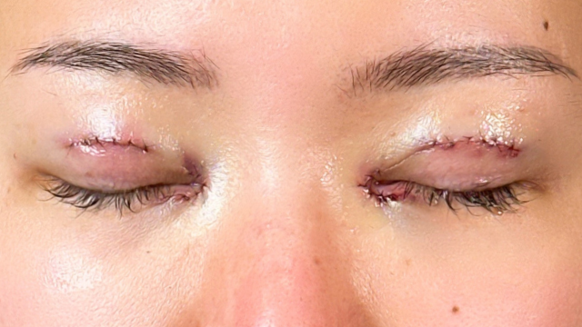 手術前の状態 その1