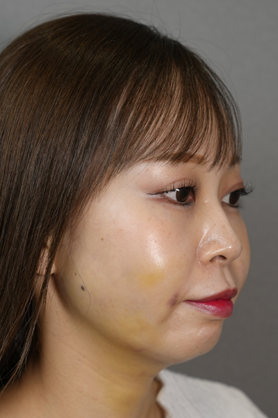 手术前的状态 其一