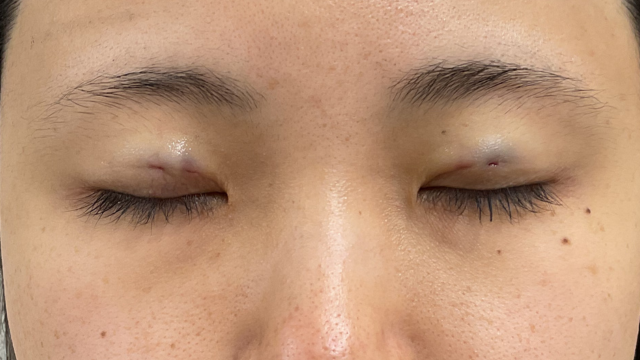 手术前的状态 其一