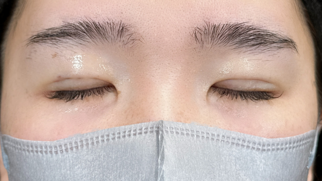 手術前の状態 その1