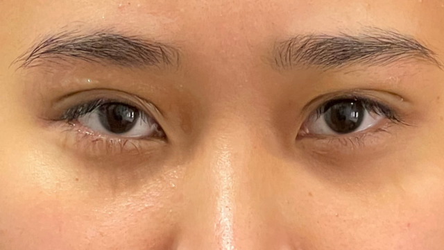 手術前の状態 その1