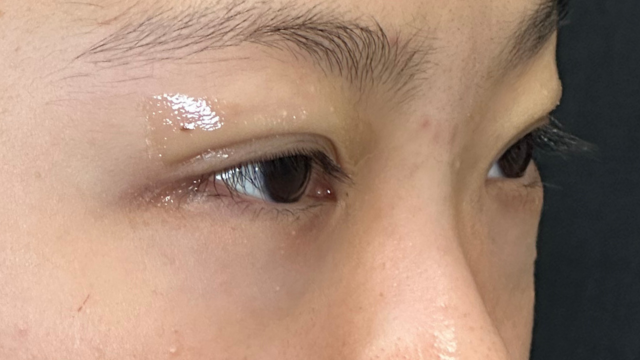 手術前の状態 その1